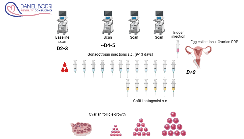 11 - Ovarian PRP Ovarian PRP treatment