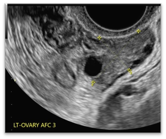 AFC Ovarian reserve testing