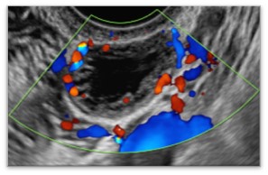 CL Ovarian reserve testing