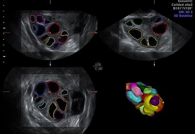 SonoAVC Advanced ultrasound diagnostics